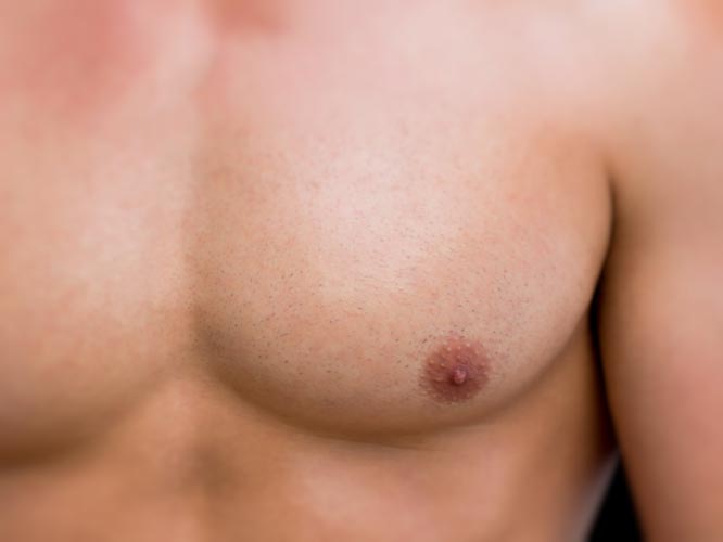 Male Breast Surgery (Gynecomastia)