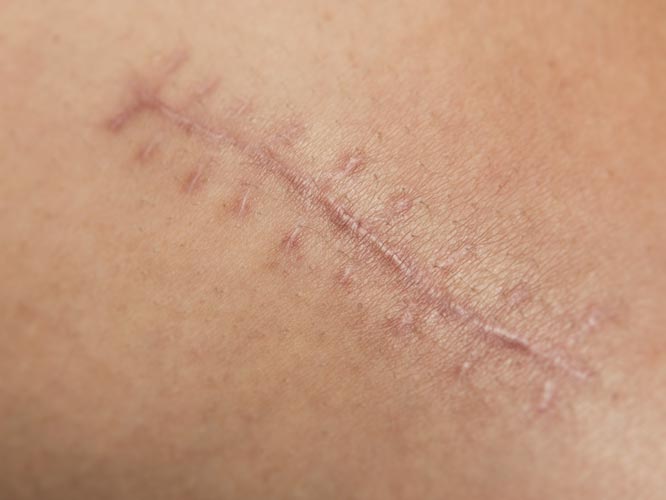 Scar Reduction and Revision